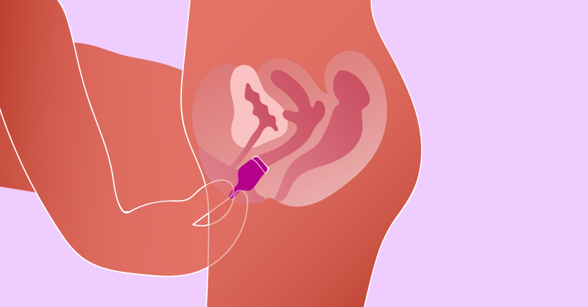 A person inserting a menstrual cup in the vagina. 