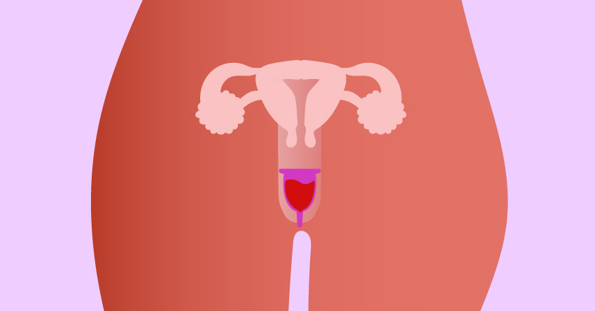 A diagram showing a menstrual cup being worn. 