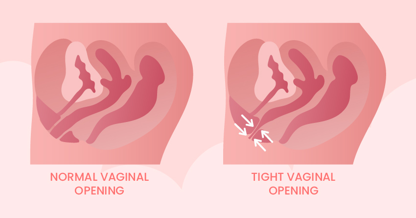 What is Vaginismus?