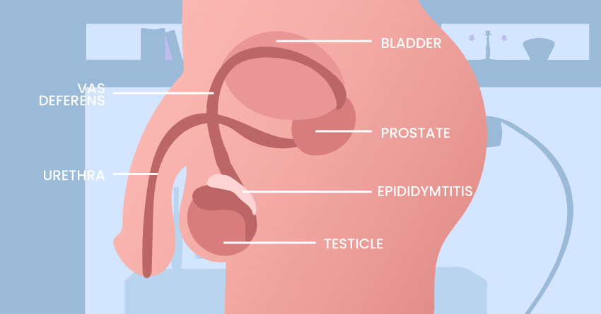 There is a risk of epididymitis. 