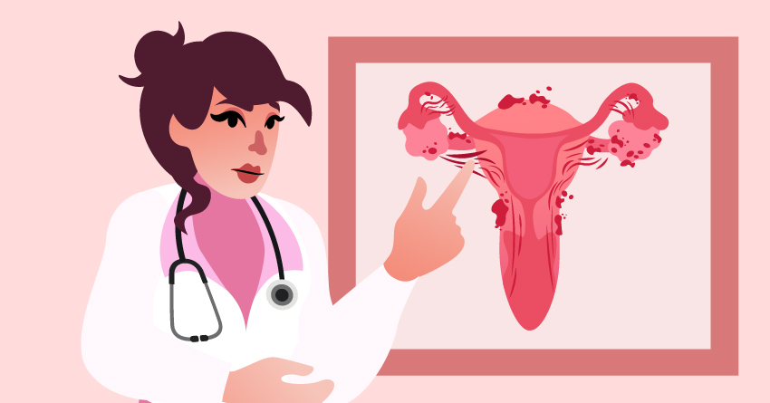 A female medical professional explaining endometriosis. 