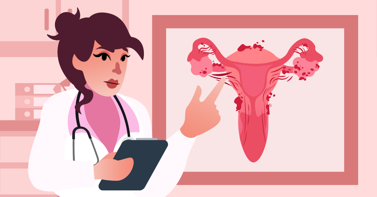 Endometriosis 101: Things You Should Know