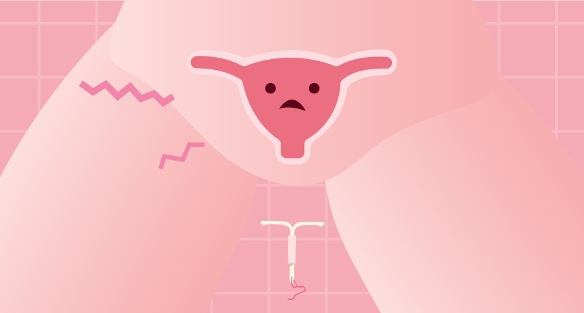 Is IUD an Effective Birth Control? Here's What You Need to Know