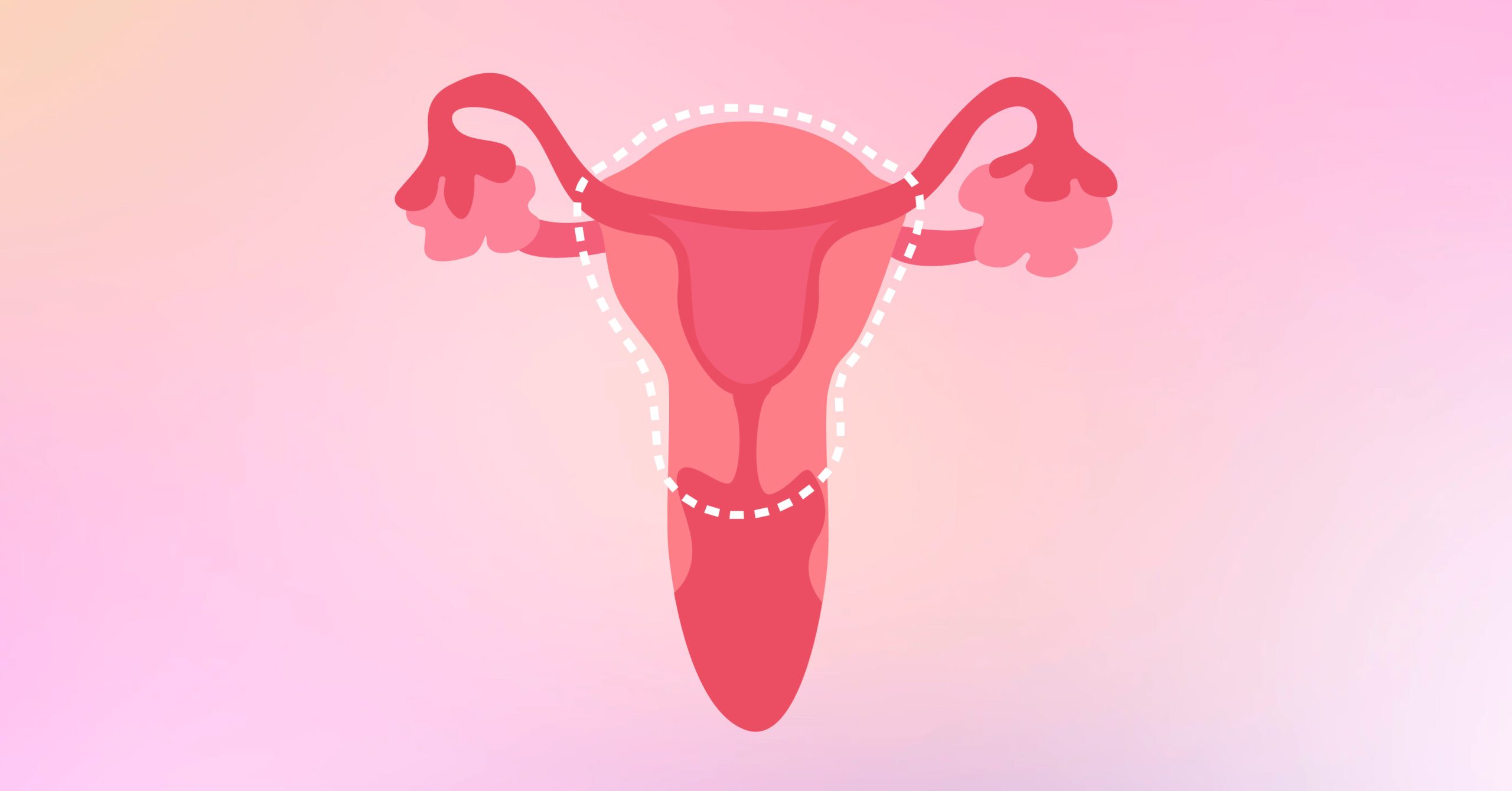 Hysterectomy 101: The Last of (Uter)us
