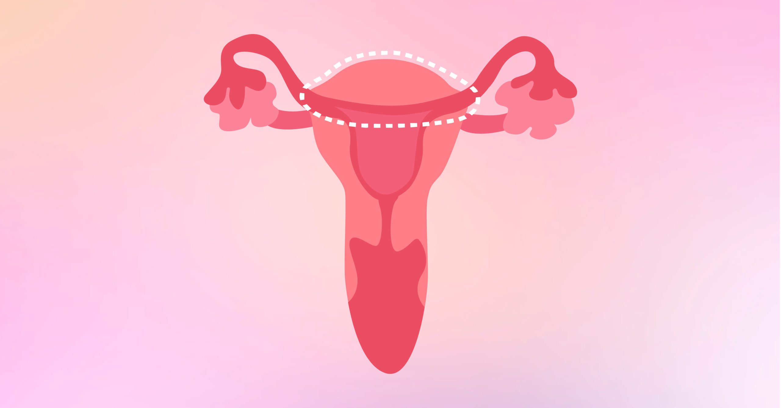 Hysterectomy 101: The Last of (Uter)us