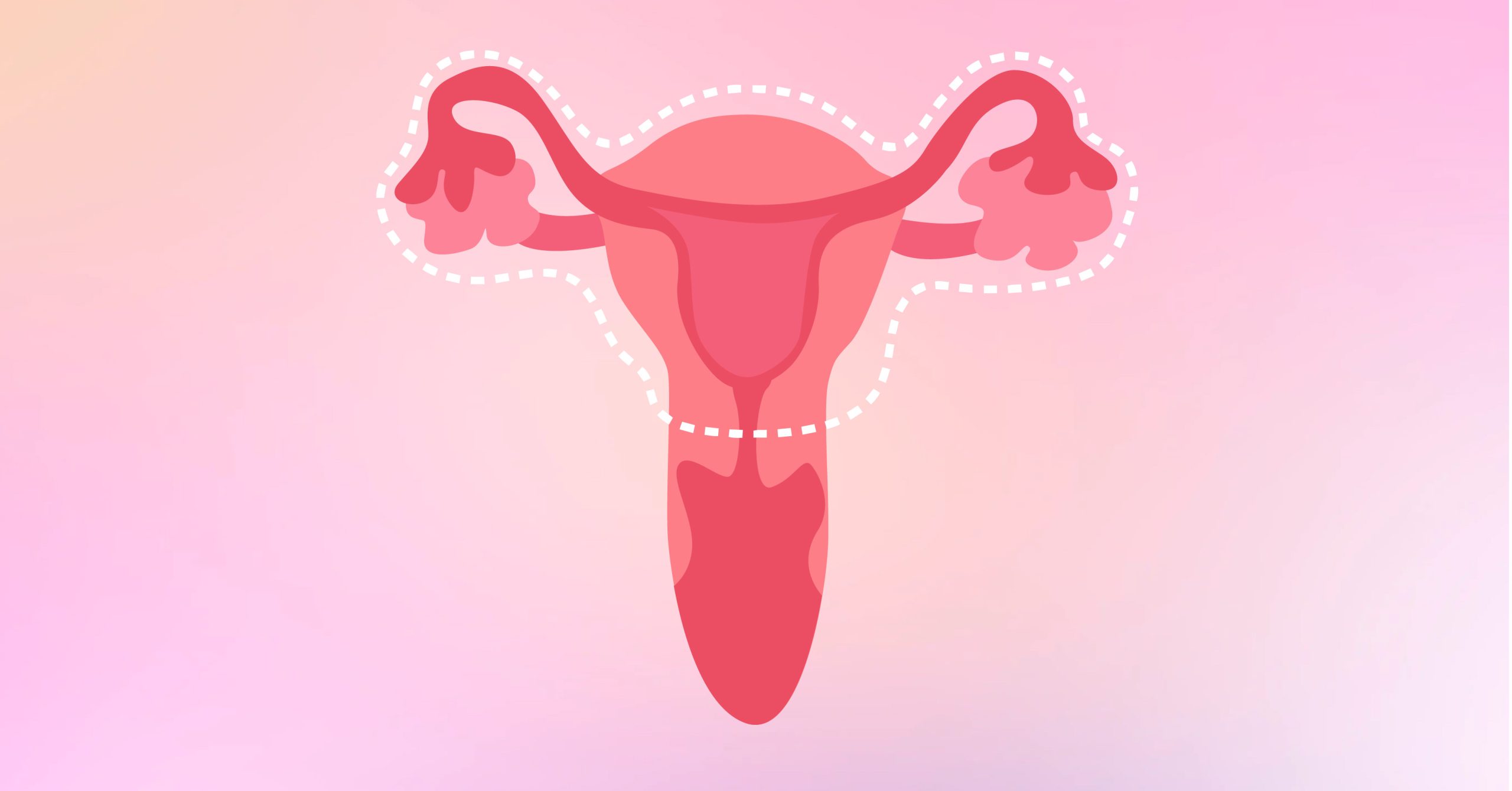 Hysterectomy 101: The Last of (Uter)us