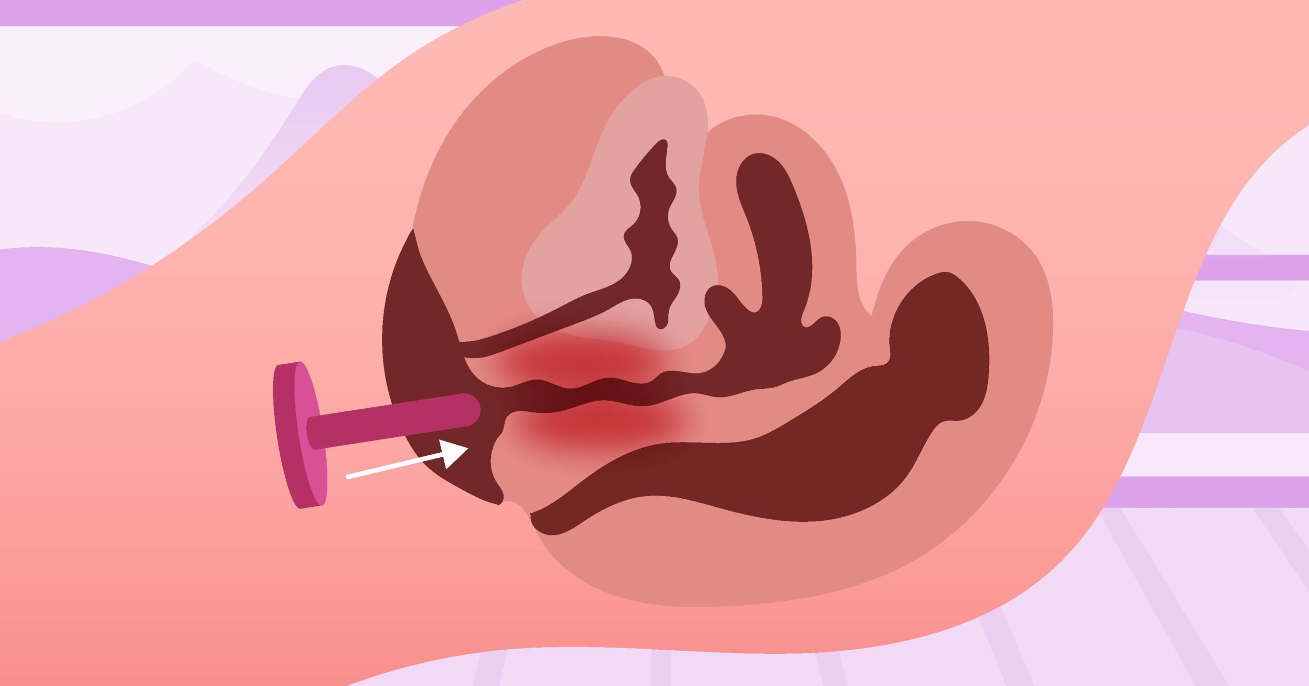 How To Use A Vaginal Dilator: 6 Steps Everyone Should Do