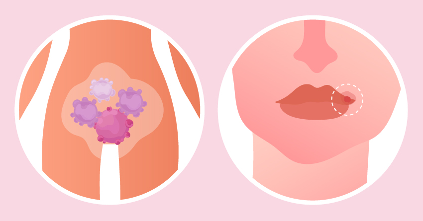 What is Human papillomavirus (HPV)?
